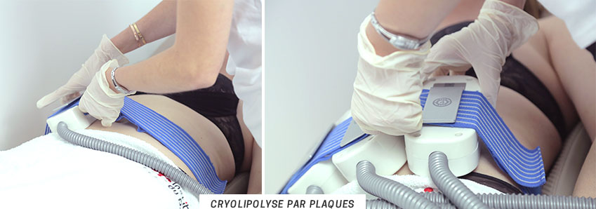 Cryolipolyse plaques ou par aspiration quelles différences ? POURQUOI LA CRYOTHÉRAPIE ?