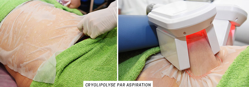 Cryolipolyse plaques ou par aspiration quelles différences ? POURQUOI LA CRYOTHÉRAPIE ?