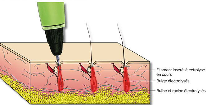 Epilation définitive : laser, lumière pulsée ou électrolyse ?