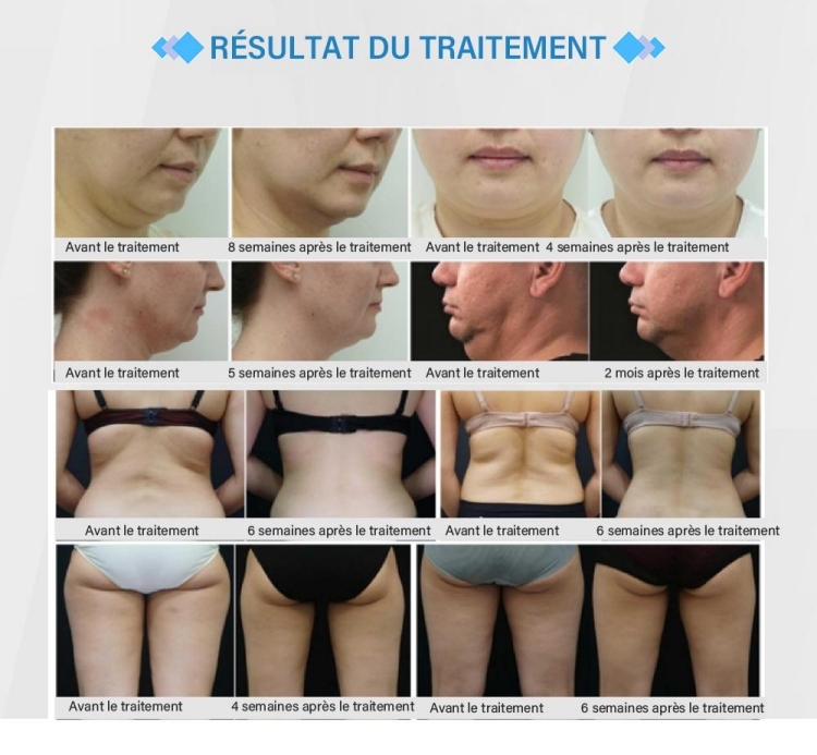 Machine de Coolsculpting 360 Coolplas