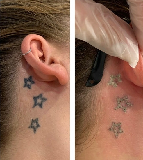 Est-il possible de supprimer complètement un tatouage ?