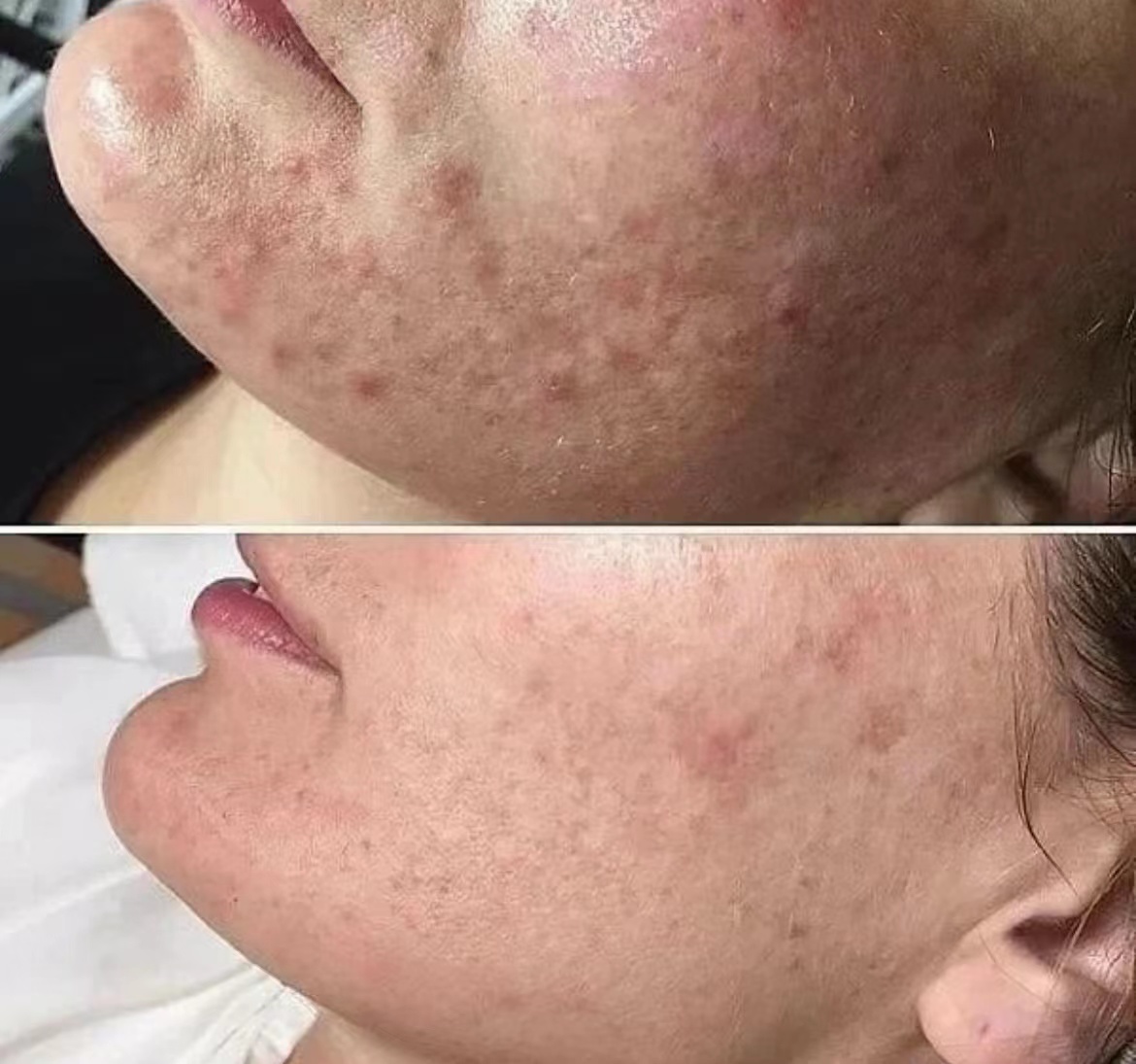 Le microneedling rf est-il vraiment efficace contre les rides ?
