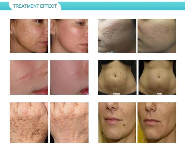 À quoi ressemblera mon visage après un laser CO2 ?