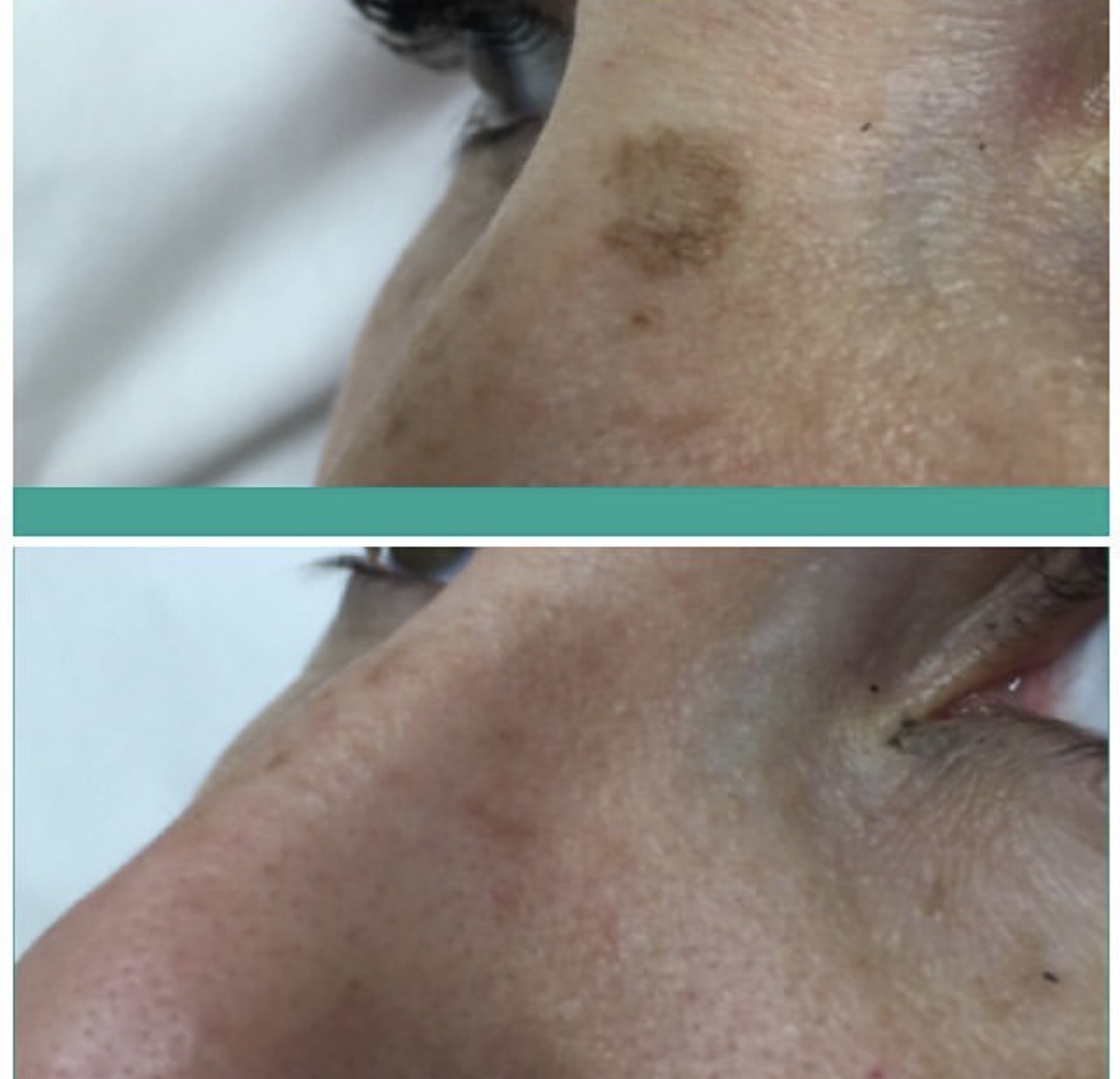 Quelle est l'efficacité d'un peeling au laser au carbone ?