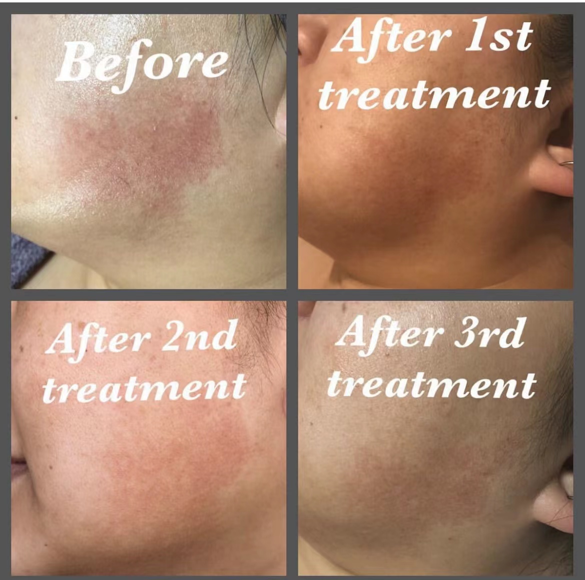 L'IPL peut-il traiter l'hyperpigmentation ?