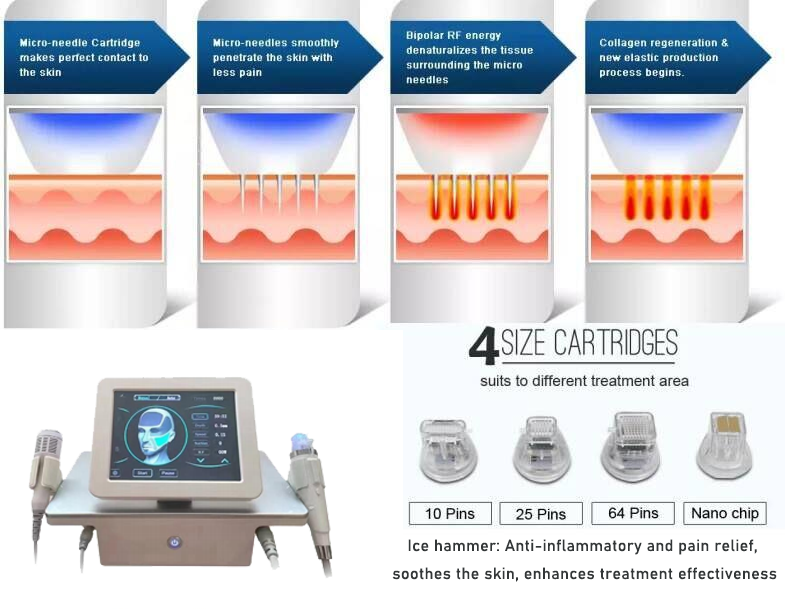 Le microneedling rf est-il vraiment efficace contre les rides ?