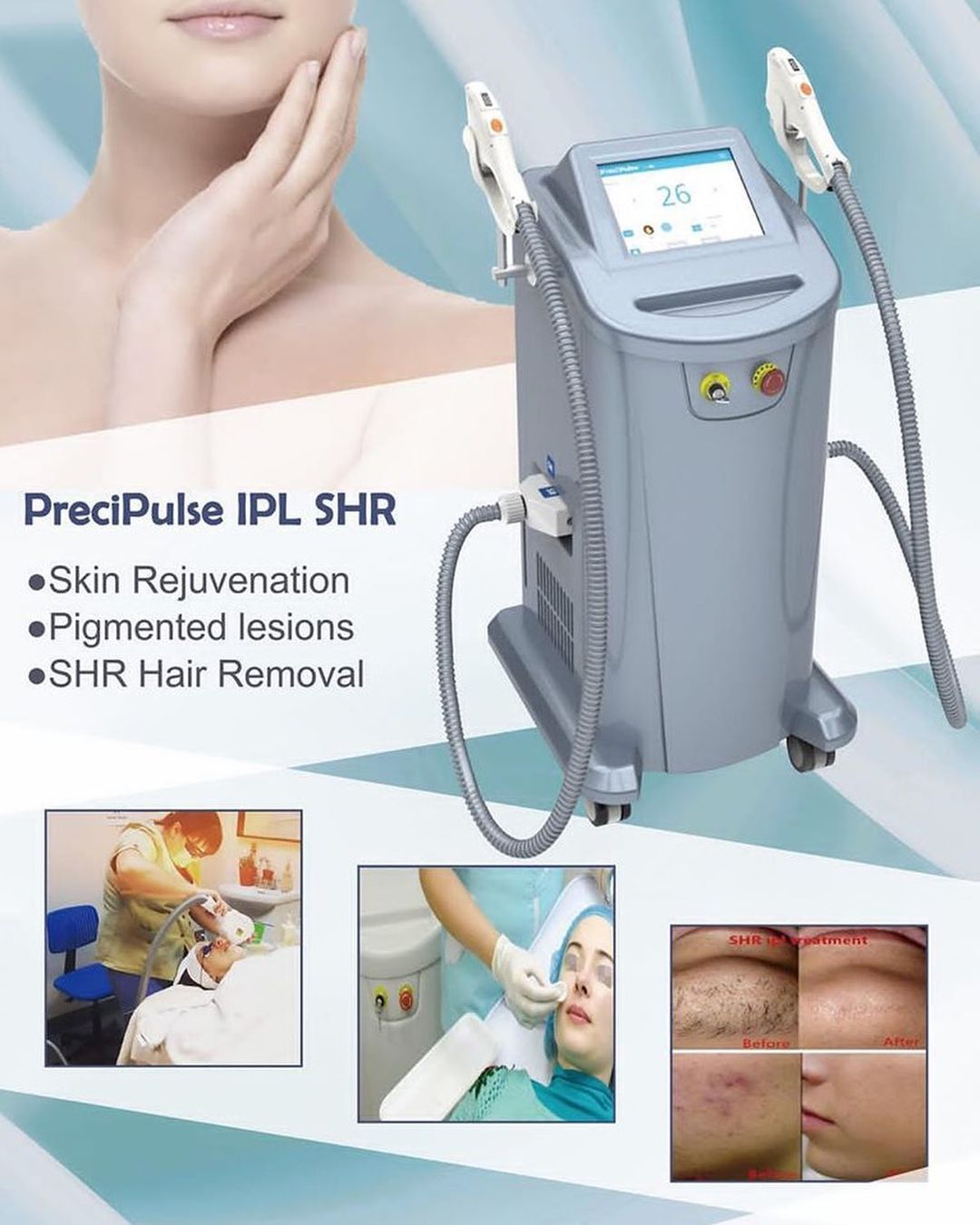 IPL peut-il éliminer les taches pigmentaires ?